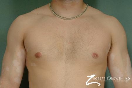 Gynecomastia: Patient 5 - After Image 1