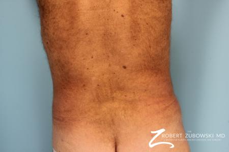 Liposuction: Patient 18 - After Image 3