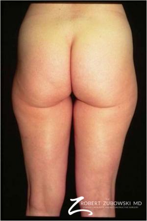 Liposuction: Patient 38 - Before Image 1
