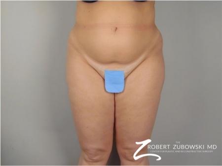 Liposuction: Patient 41 - Before Image 1