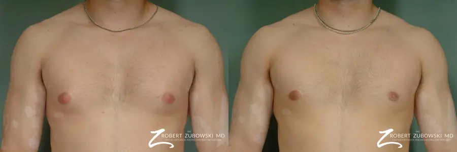 Gynecomastia: Patient 5 - Before and After 1