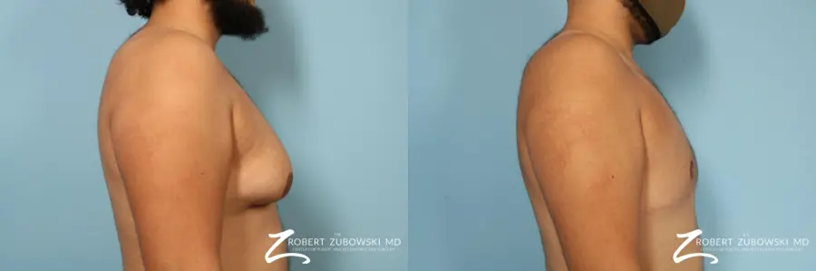 Gynecomastia: Patient 15 - Before and After 2