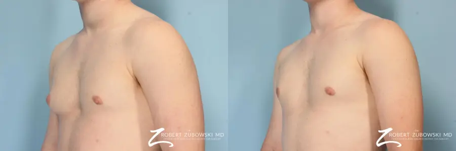 Gynecomastia: Patient 9 - Before and After 3
