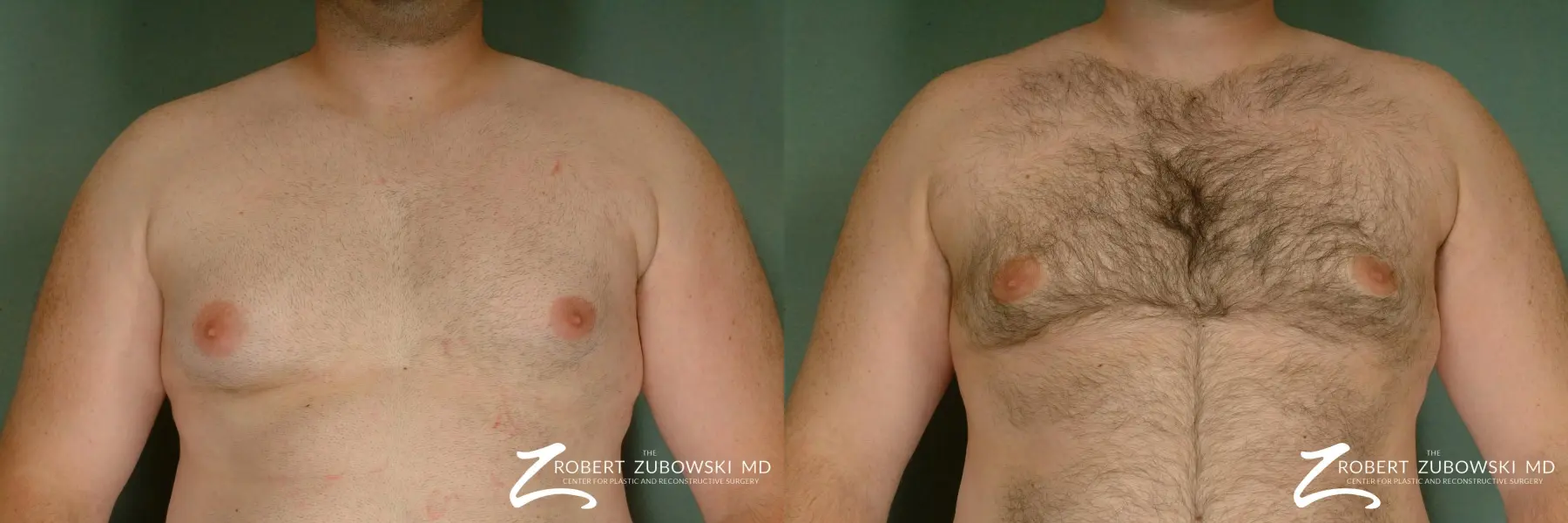 Gynecomastia: Patient 2 - Before and After  