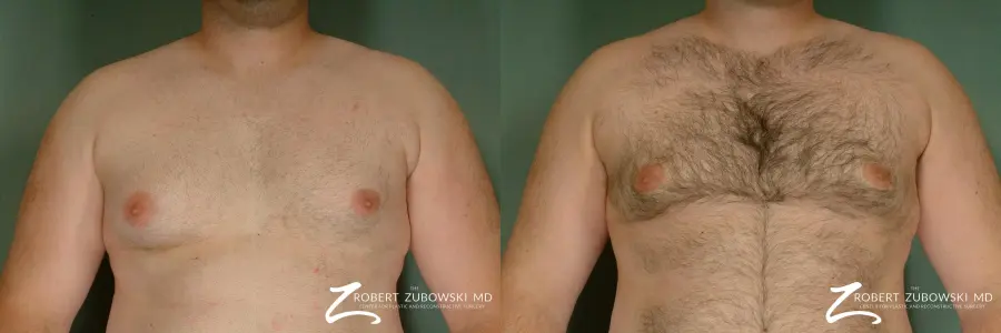 Gynecomastia: Patient 7 - Before and After 1