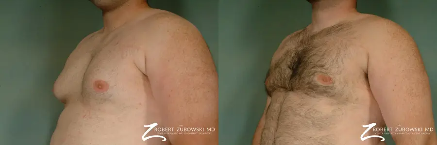 Gynecomastia: Patient 2 - Before and After 2