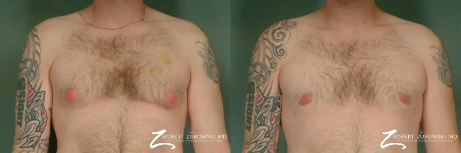 Gynecomastia: Patient 2 - Before and After 1