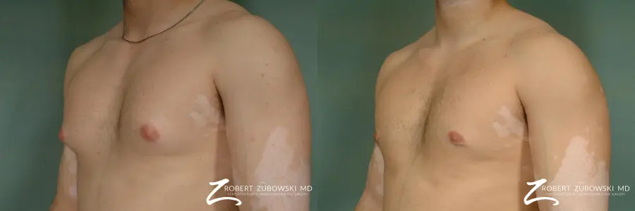 Gynecomastia: Patient 5 - Before and After 2