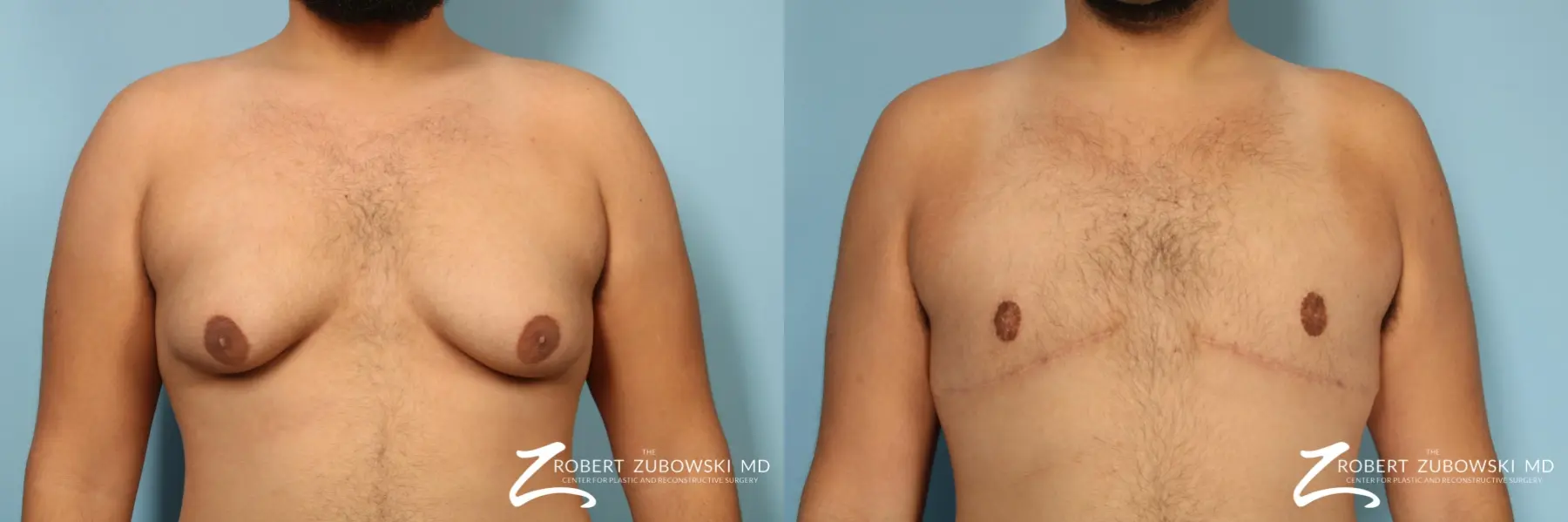 Gynecomastia: Patient 14 - Before and After  