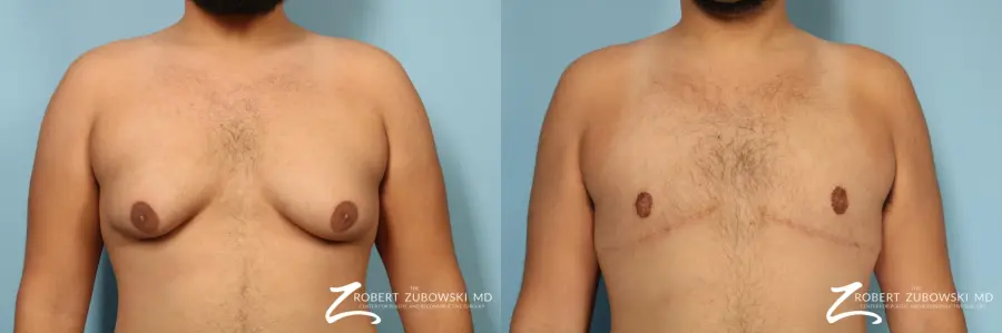 Gynecomastia: Patient 13 - Before and After 1