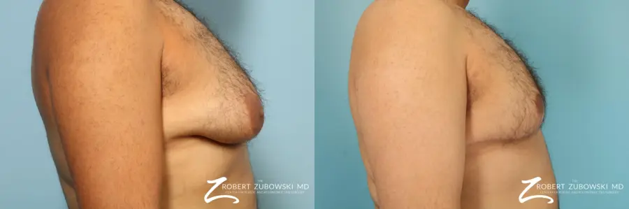 Gynecomastia: Patient 14 - Before and After 2