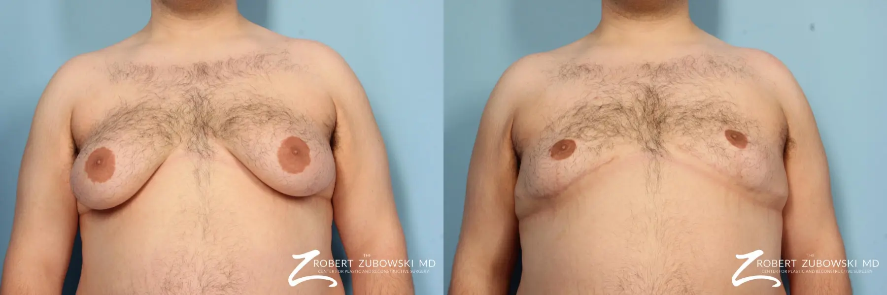 Gynecomastia: Patient 6 - Before and After  