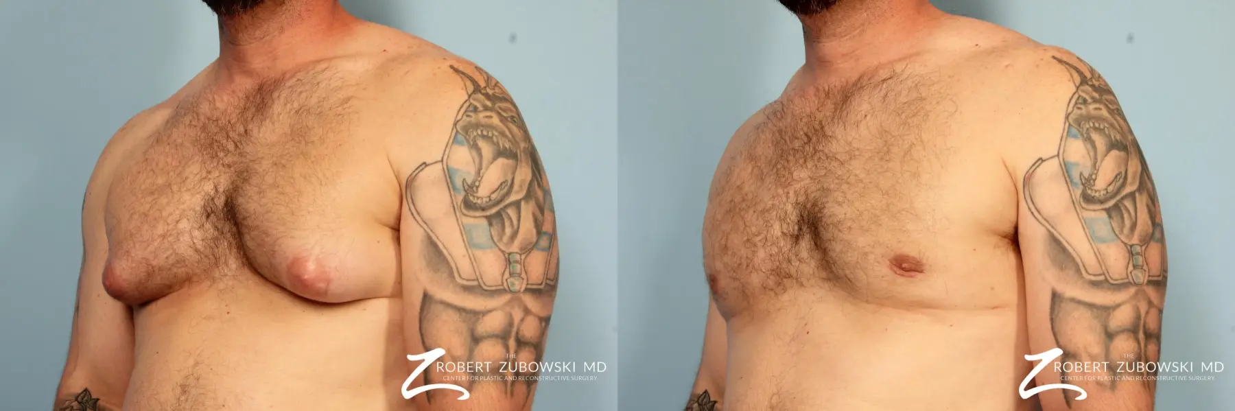 Gynecomastia: Patient 13 - Before and After 2