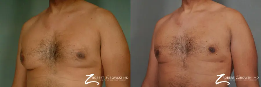 Gynecomastia: Patient 7 - Before and After 2