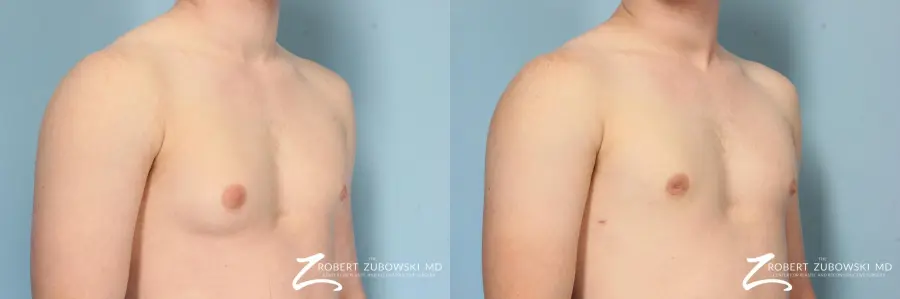 Gynecomastia: Patient 9 - Before and After 2