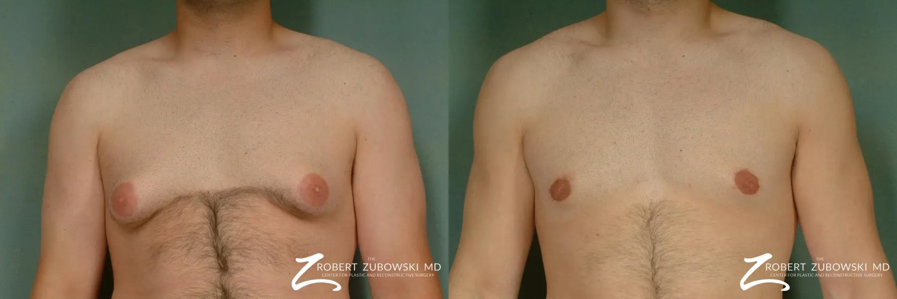 Gynecomastia: Patient 12 - Before and After 1