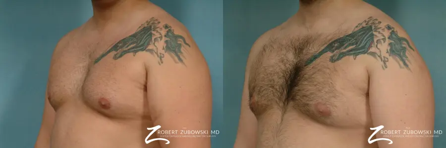 Gynecomastia: Patient 10 - Before and After 2