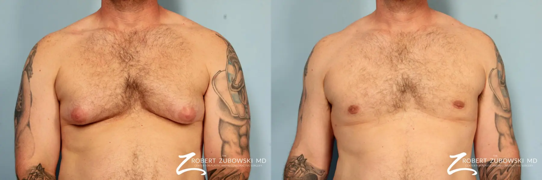 Gynecomastia: Patient 13 - Before and After  