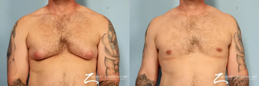 Gynecomastia: Patient 13 - Before and After 1