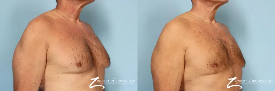 Gynecomastia: Patient 8 - Before and After 2
