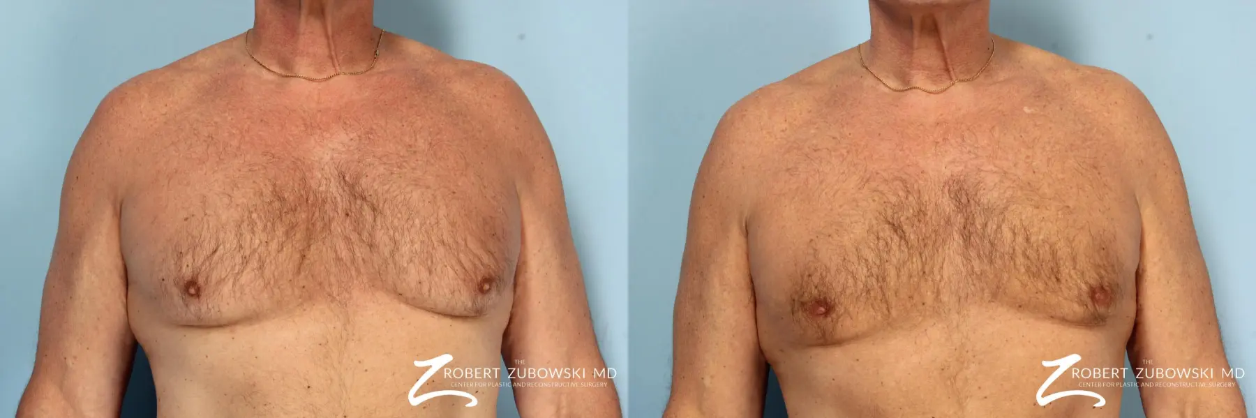 Gynecomastia Before & After Gallery: Patient 8