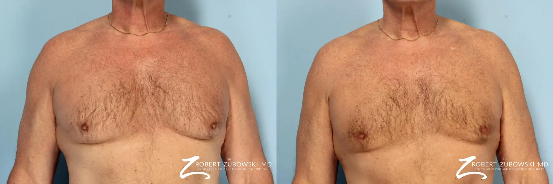 Gynecomastia: Patient 8 - Before and After  