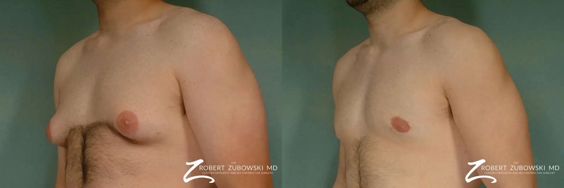 Gynecomastia: Patient 12 - Before and After 2