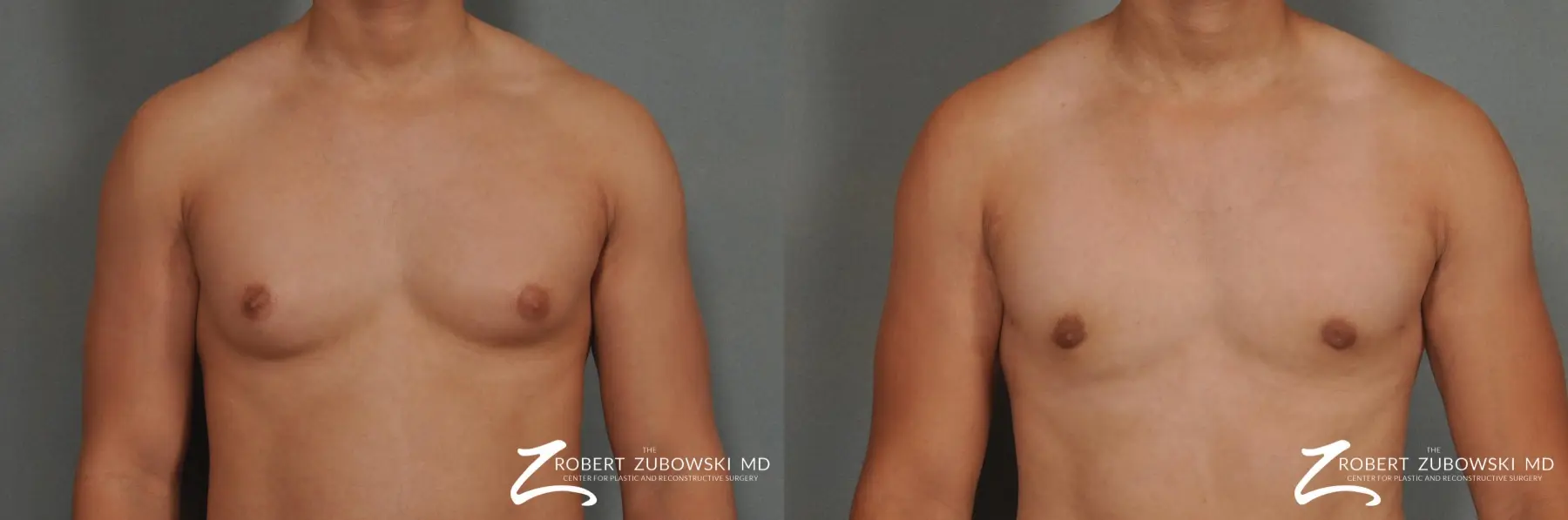 Gynecomastia: Patient 3 - Before and After 1