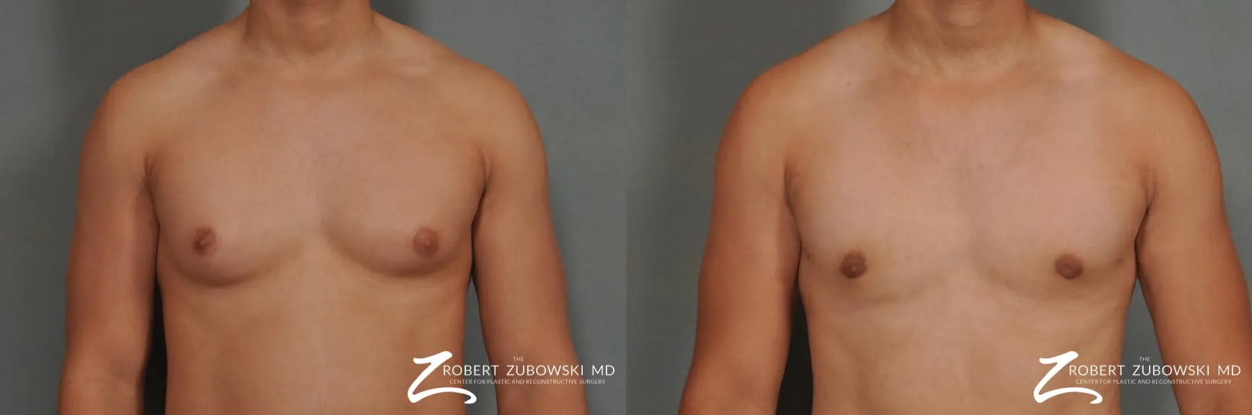 Gynecomastia: Patient 3 - Before and After  