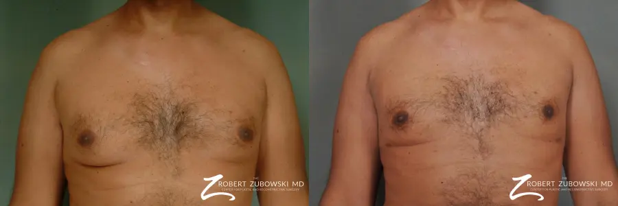 Gynecomastia: Patient 7 - Before and After 1
