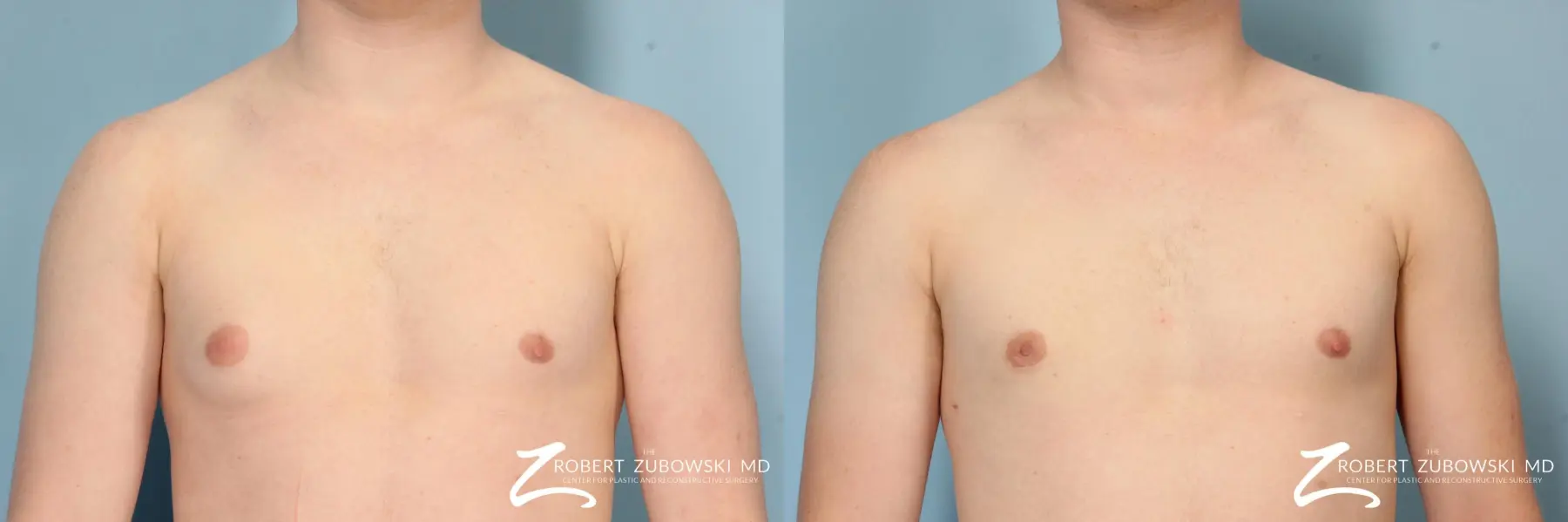 Gynecomastia: Patient 9 - Before and After  