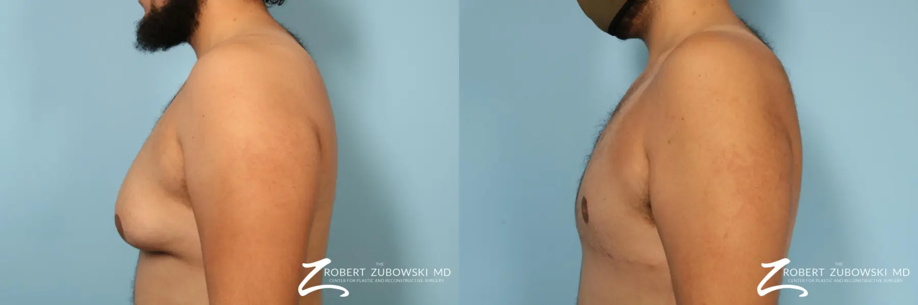 Gynecomastia: Patient 14 - Before and After 2