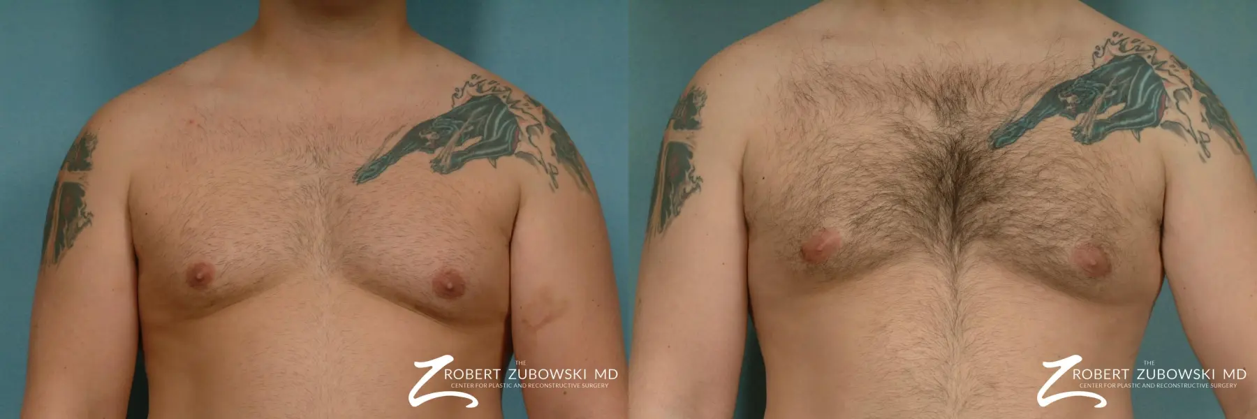 Gynecomastia: Patient 10 - Before and After  