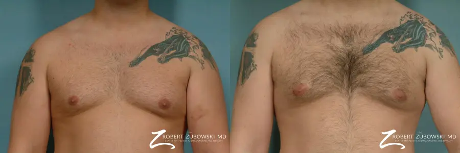 Gynecomastia: Patient 10 - Before and After  