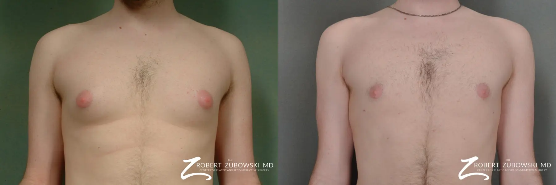 Gynecomastia: Patient 4 - Before and After  