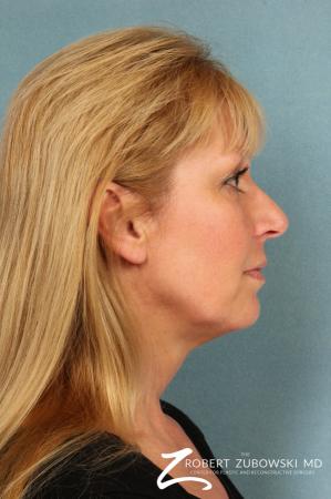 Rhinoplasty: Patient 17 - Before and After Image 2