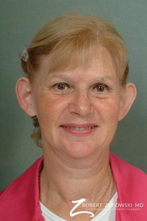 Otoplasty: Patient 2 - Before Image 1