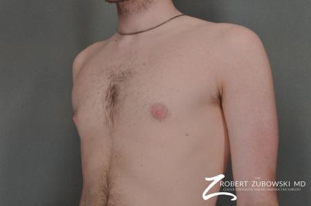 Gynecomastia: Patient 4 - After Image 2