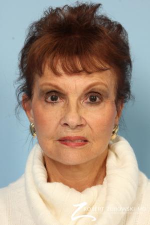 Facelift: Patient 24 - After Image 1