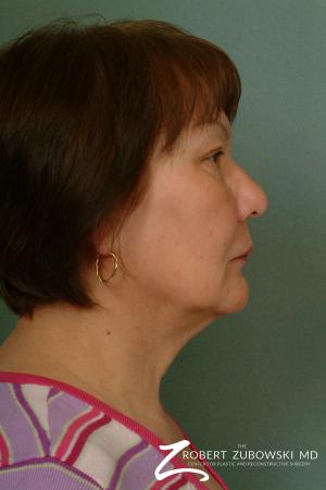 Blepharoplasty: Patient 23 - After Image 2