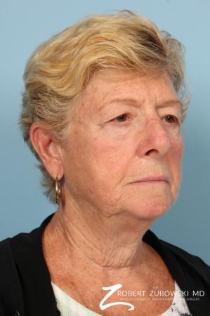 Blepharoplasty: Patient 30 - Before and After Image 2