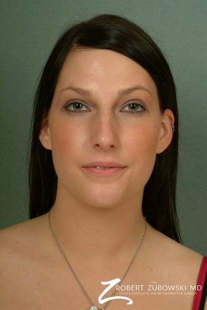 Rhinoplasty: Patient 2 - Before Image 1