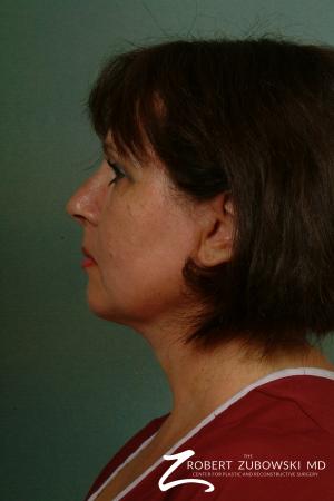 Neck Lift: Patient 8 - After Image 2