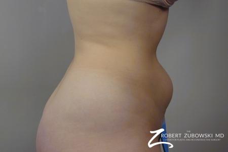 Liposuction: Patient 29 - Before Image 3