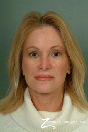 Facelift: Patient 12 - After Image 1