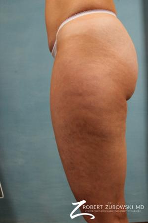 Cellulaze: Patient 1 - Before Image 1