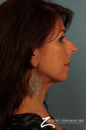 Neck Lift: Patient 4 - After Image 2