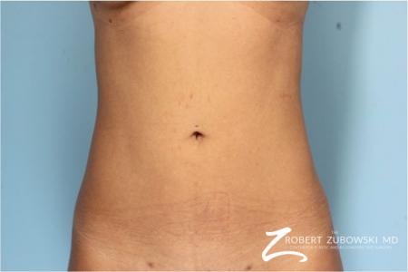 Liposuction: Patient 40 - After Image 1