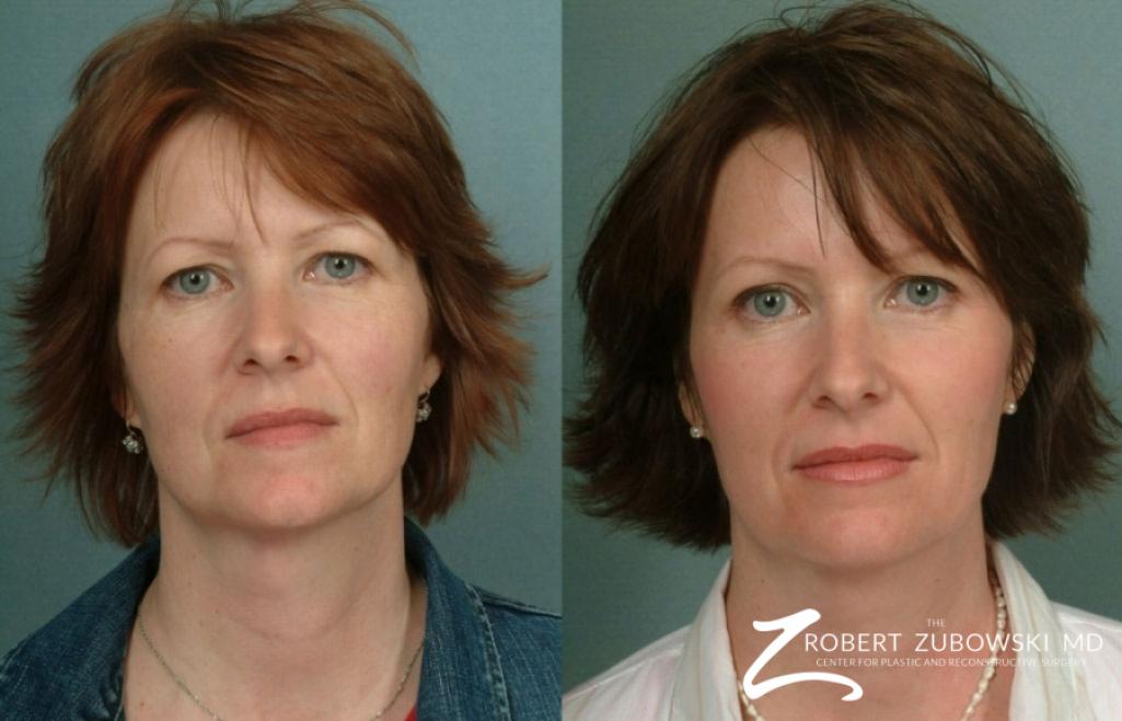 Laser: Patient 7 - Before and After  