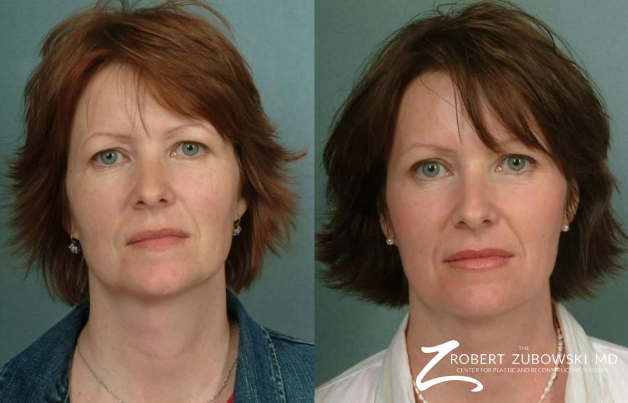 Laser: Patient 6 - Before and After Image 1